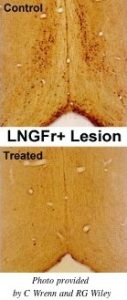 LNGFr +病变